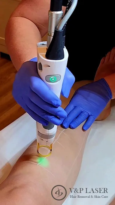 V&P Laser Hair Removal & Skin Care Picture 9