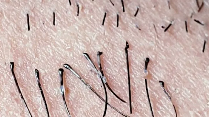 Electrolysis 100% Permanent Hair Removal & Skin Care Picture 6