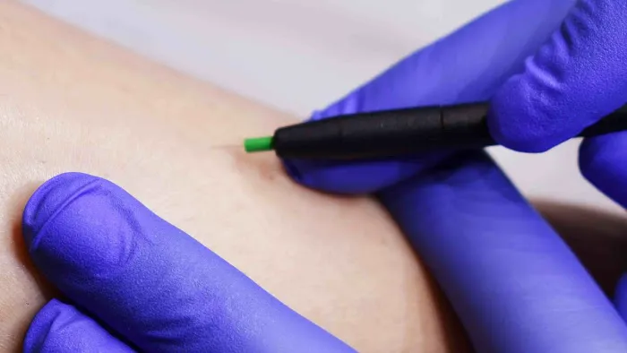 Electrolysis 100% Permanent Hair Removal & Skin Care Picture 5