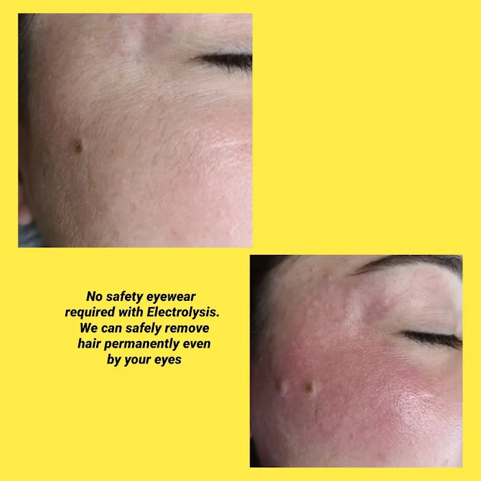 Electrolysis For You Picture 5