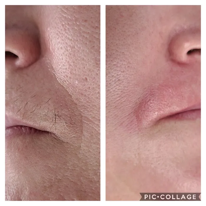Electrolysis For You Picture 4