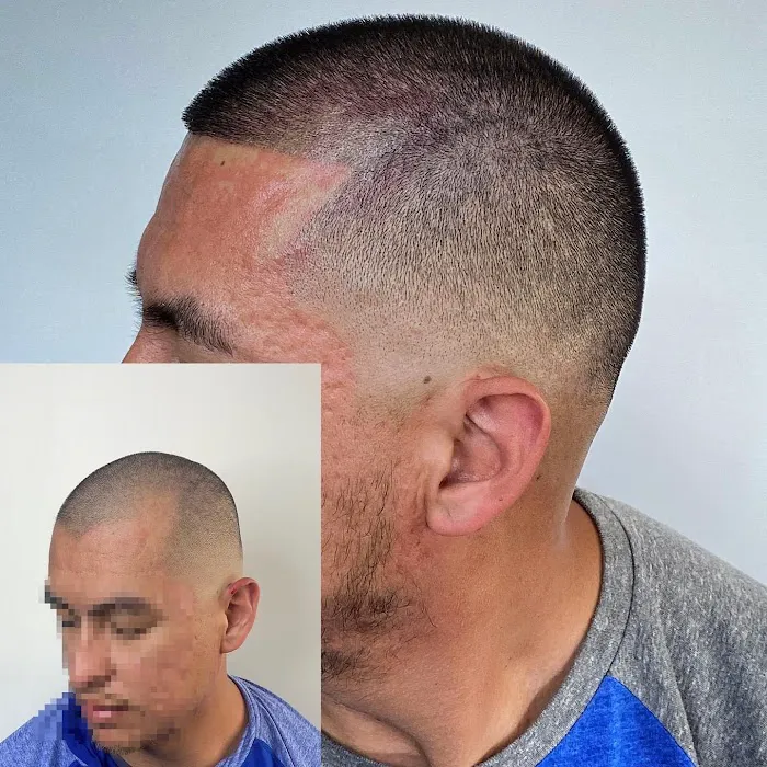 Fred312 scalp micropigmentation Picture 4