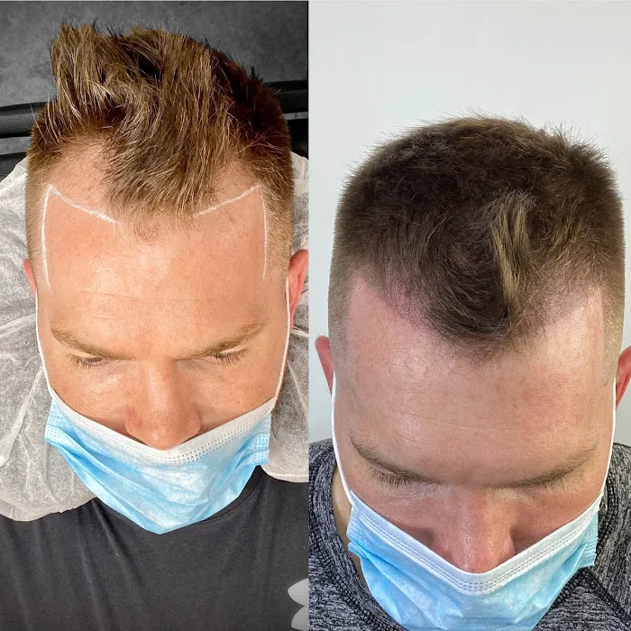 Fred312 scalp micropigmentation Picture 10