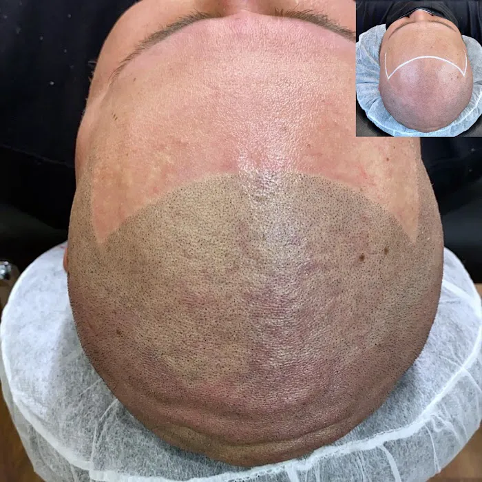 Fred312 scalp micropigmentation Picture 2