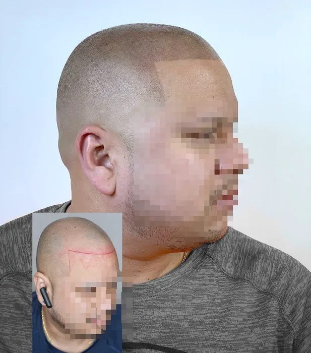 Fred312 scalp micropigmentation Picture 1