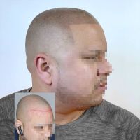 Fred312 scalp micropigmentation ico