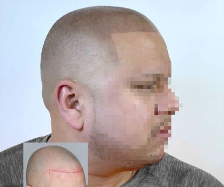 Fred312 scalp micropigmentation