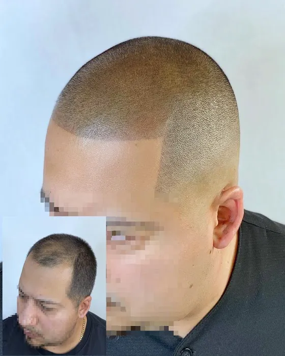 Fred312 scalp micropigmentation Picture 8