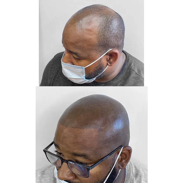 Fred312 scalp micropigmentation Picture 5