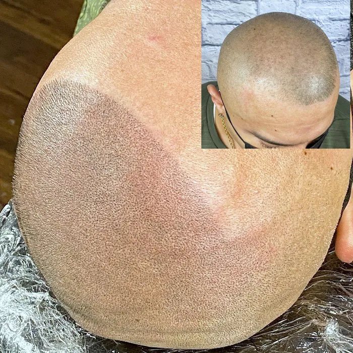 Fred312 scalp micropigmentation Picture 7
