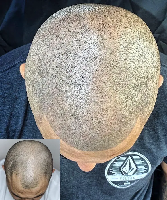Fred312 scalp micropigmentation Picture 9