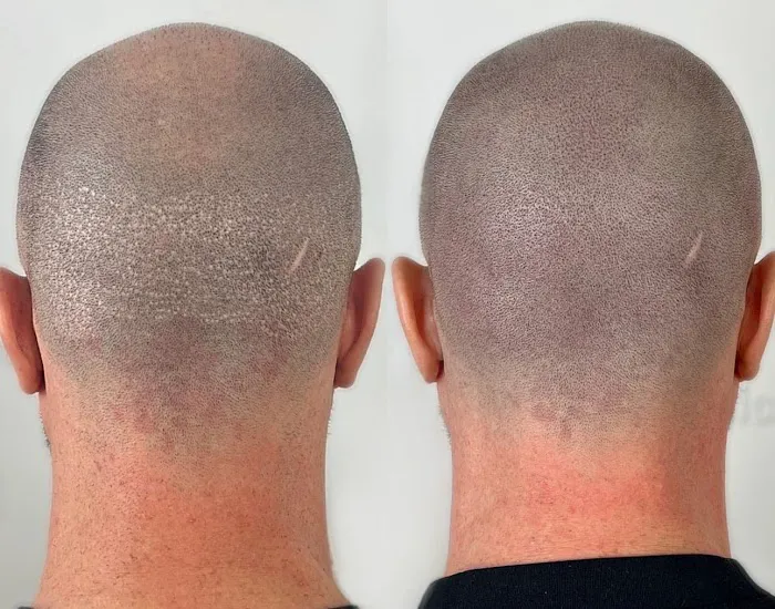 Picasso Scalp Micropigmentation- Chicago Picture 8