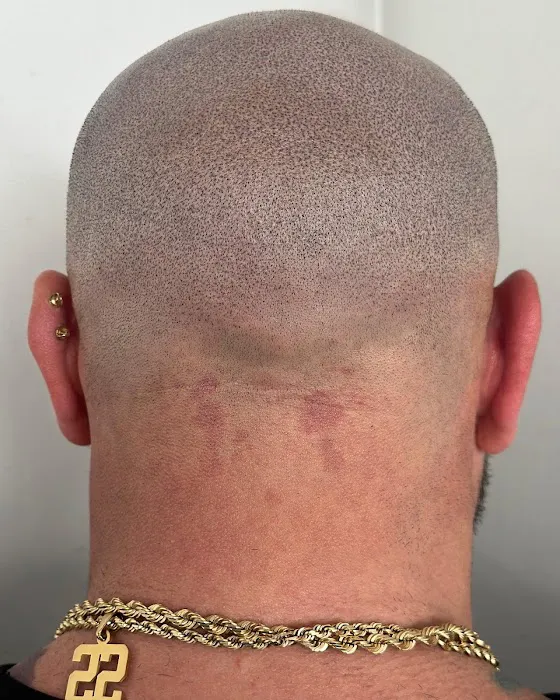 Picasso Scalp Micropigmentation- Chicago Picture 9