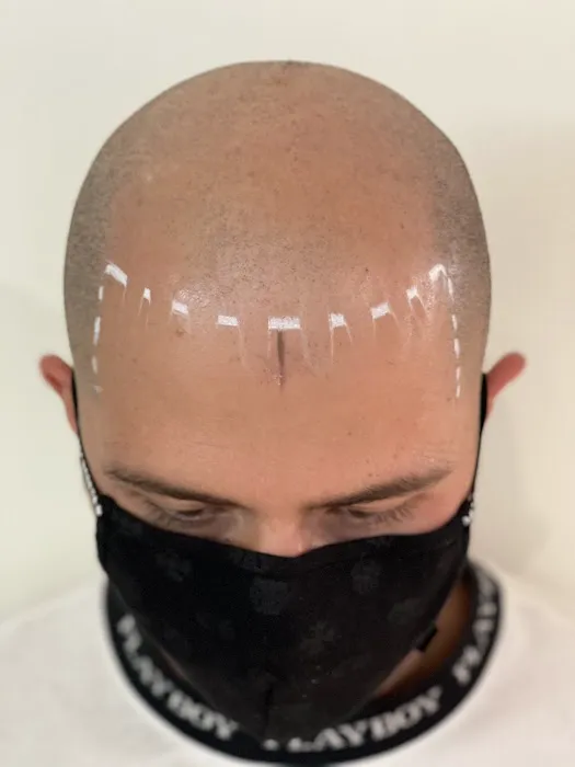 Picasso Scalp Micropigmentation- Chicago Picture 1