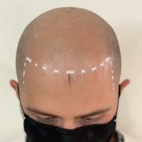 Picasso Scalp Micropigmentation- Chicago ico