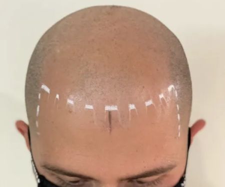Picasso Scalp Micropigmentation- Chicago