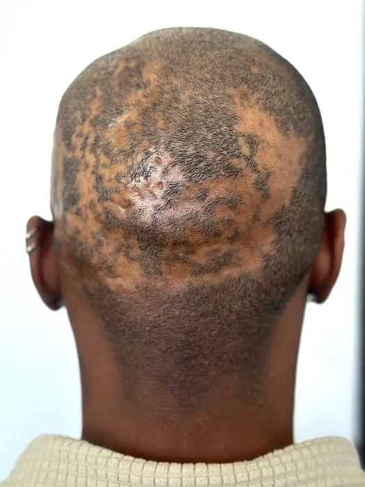 Picasso Scalp Micropigmentation- Chicago Picture 5