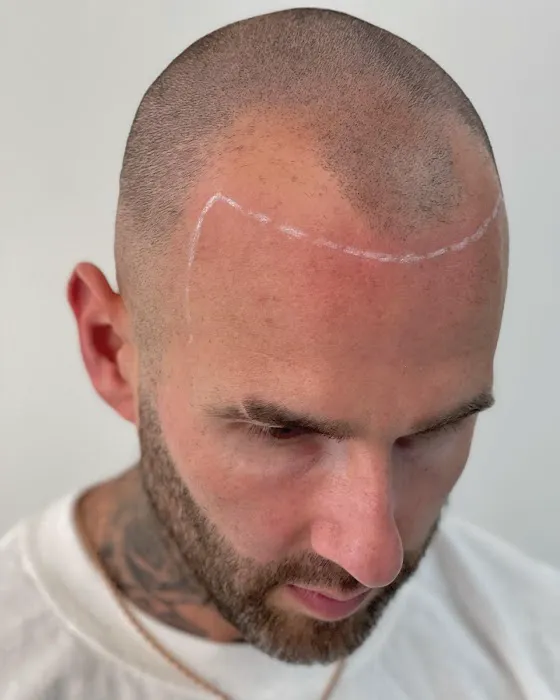 Picasso Scalp Micropigmentation- Chicago Picture 3