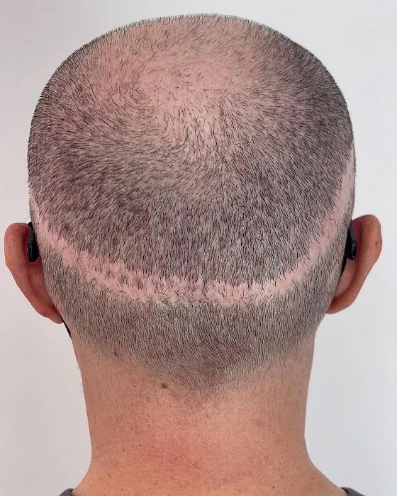 Picasso Scalp Micropigmentation- Chicago Picture 7