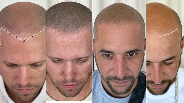 Picasso Scalp Micropigmentation- Chicago Picture 2