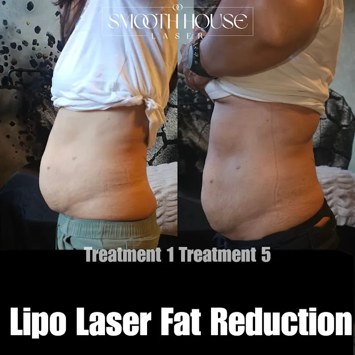 Smooth House Laser Spa Picture 9