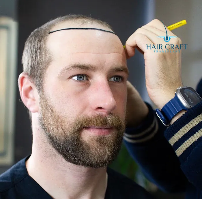 HairCraft Transplant Picture 4
