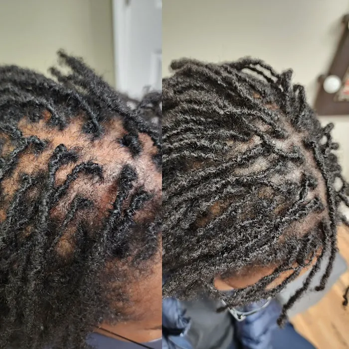 OM SCALP Micropigmentation Hair Tattoo Picture 5