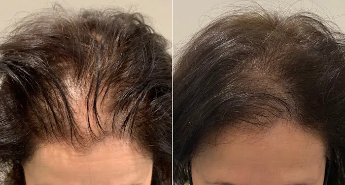 OM SCALP Micropigmentation Hair Tattoo Picture 4
