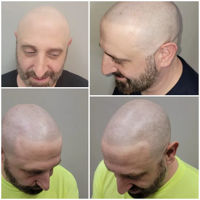 OM SCALP Micropigmentation Hair Tattoo Picture 9