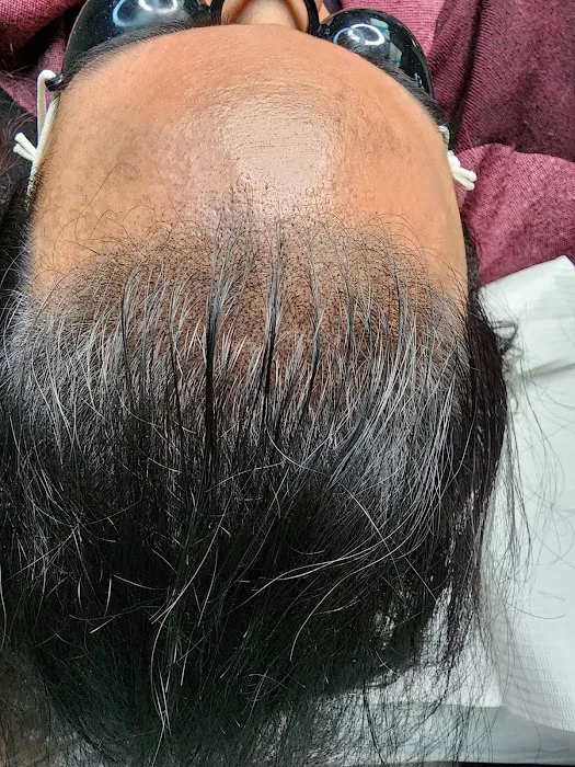 OM SCALP Micropigmentation Hair Tattoo Picture 3