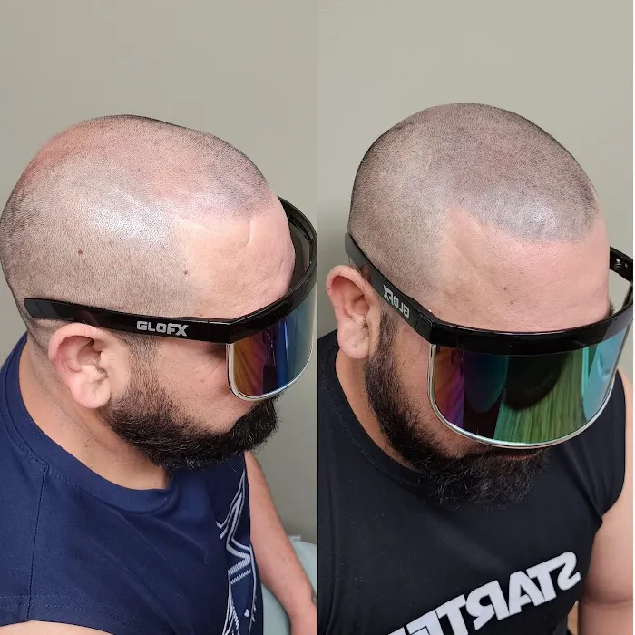 OM SCALP Micropigmentation Hair Tattoo Picture 8