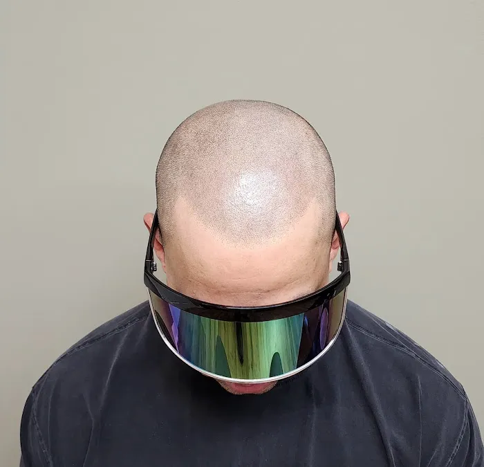 OM SCALP Micropigmentation Hair Tattoo Picture 6