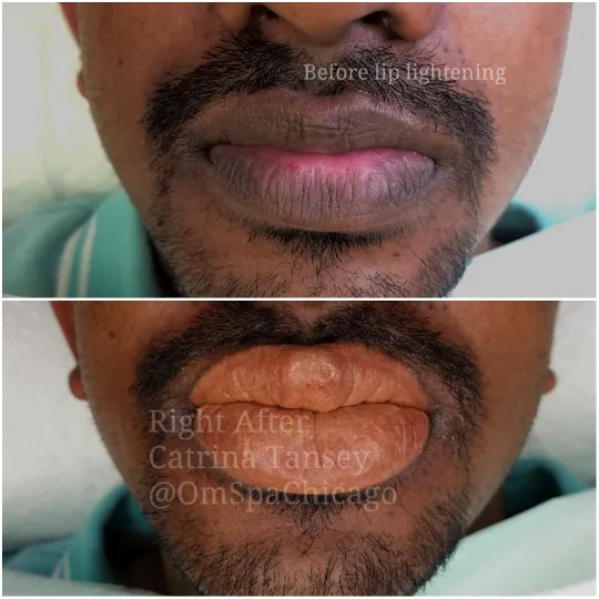 OM SCALP Micropigmentation Hair Tattoo Picture 10