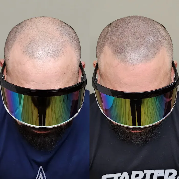 OM SCALP Micropigmentation Hair Tattoo Picture 1