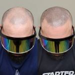 OM SCALP Micropigmentation Hair Tattoo