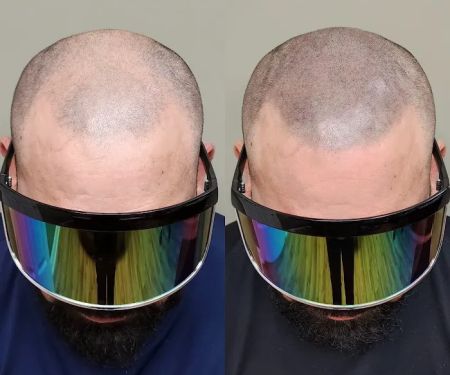 OM SCALP Micropigmentation Hair Tattoo