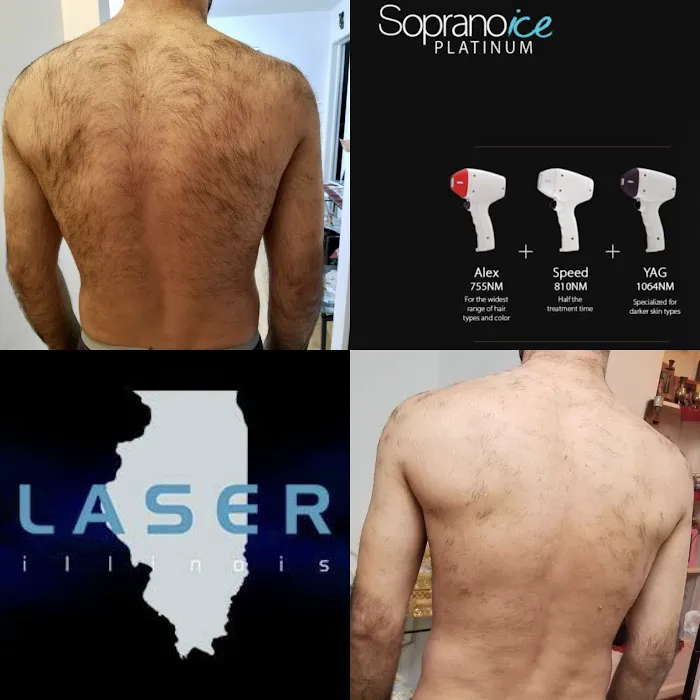 Laser Illinois Picture 4