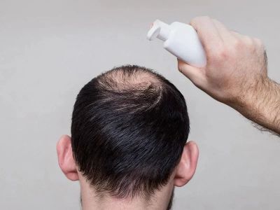 How to Prevent Hair Thinning in Men Naturally