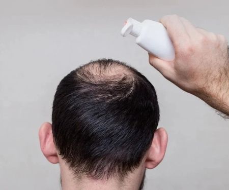 How to Prevent Hair Thinning in Men Naturally